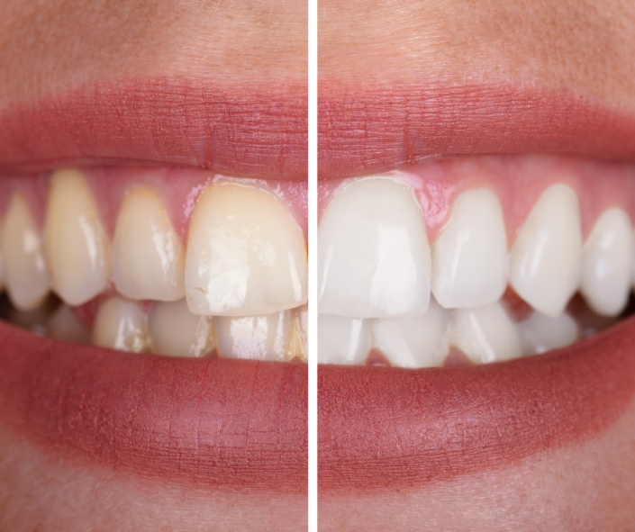 Before and after comparison of teeth whitening treatment, showing a set of teeth with plaque and discoloration on the left and bright, white, clean teeth on the right, illustrating the effectiveness of dental cleaning services.